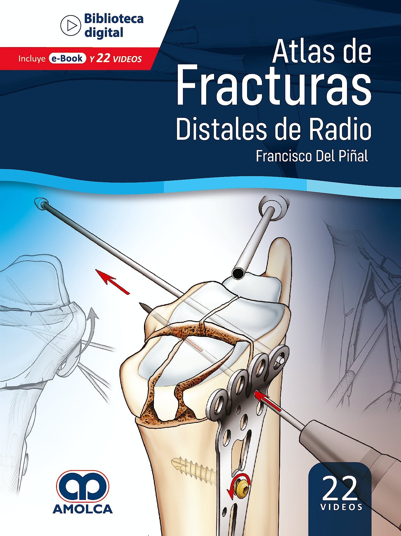 ATLAS DE FRACTURAS DISTALES DE RADIO - DEL PIÑAL