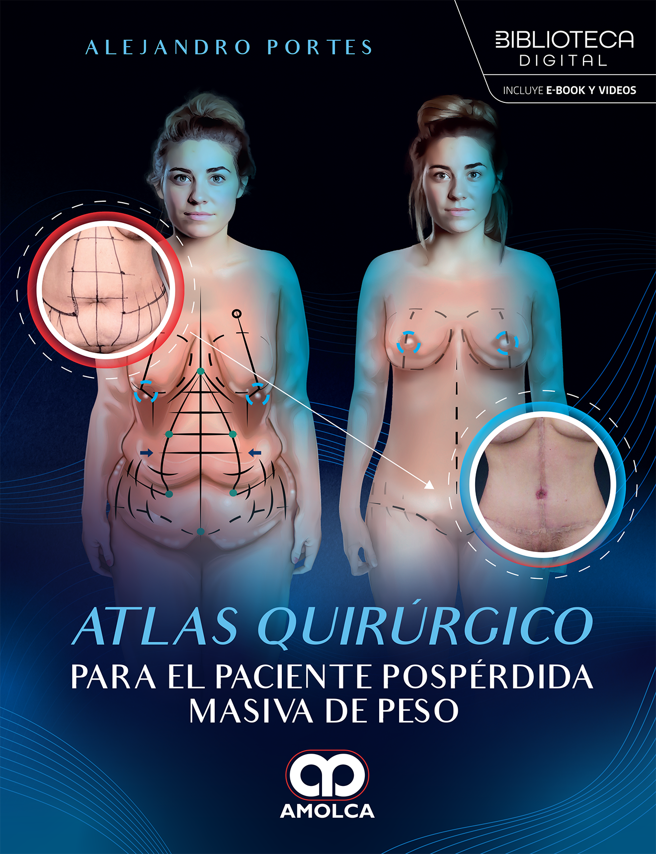 ATLAS QUIRURGICO PARA EL PACIENTE POSPERDIDA MASIVA DE PESO - PORTES