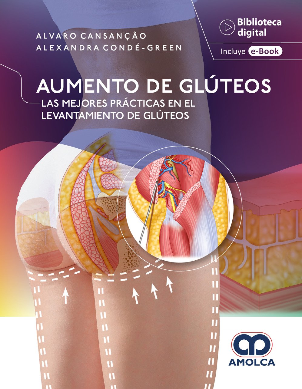 AUMENTO DE GLUTEOS LAS MEJORES PRACTICAS EN EL LEVANTAMIENTO DE GLUTEOS 1ED - CANSANÇÃO