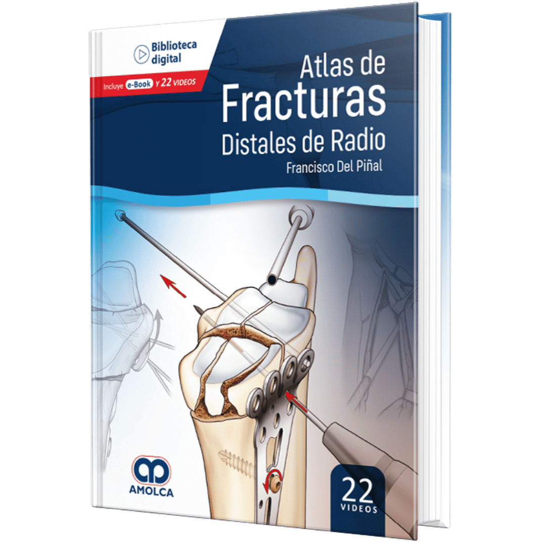 Atlas de Fracturas Distales de radio Del Piñal