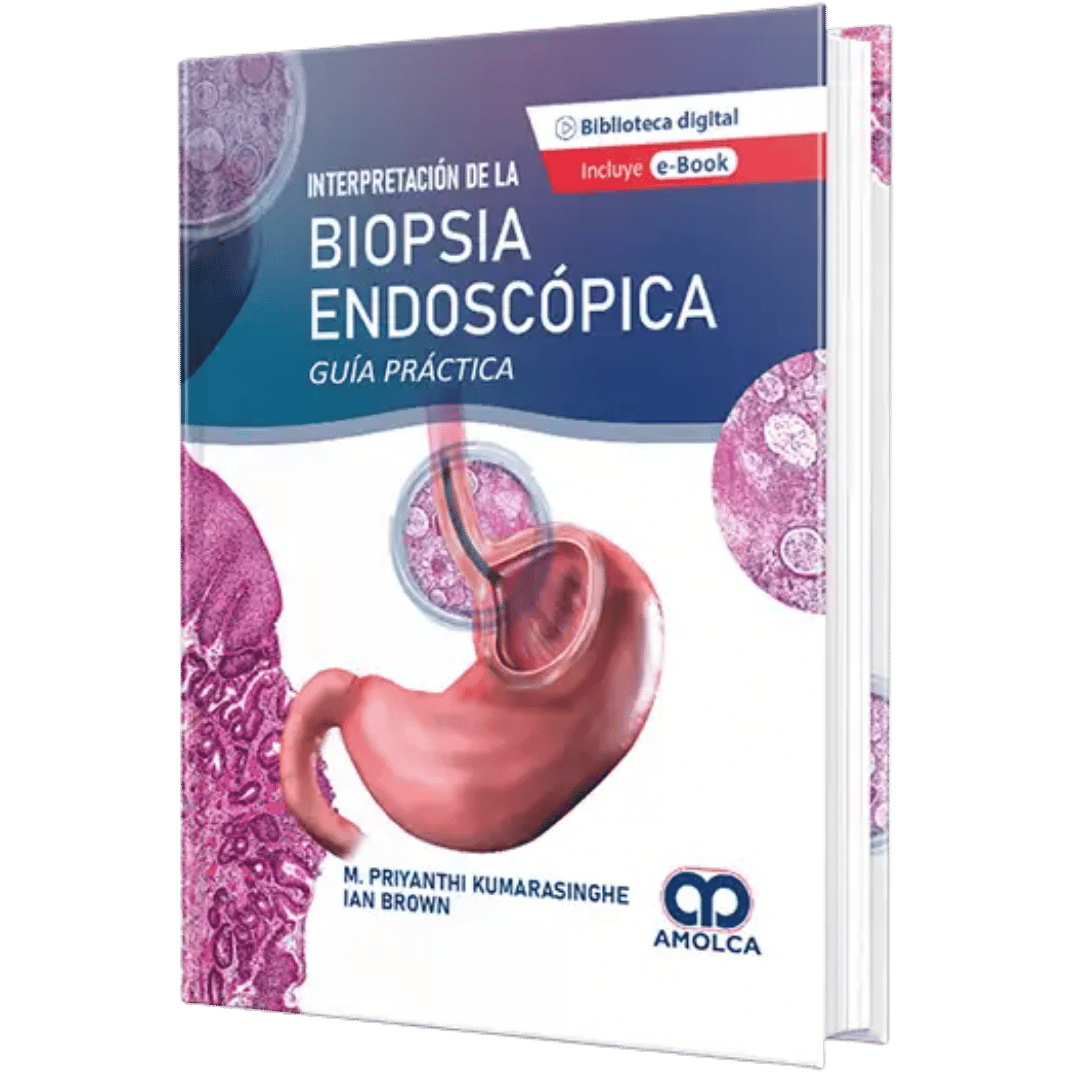 Biopsia Endoscópica Kumarasinghe