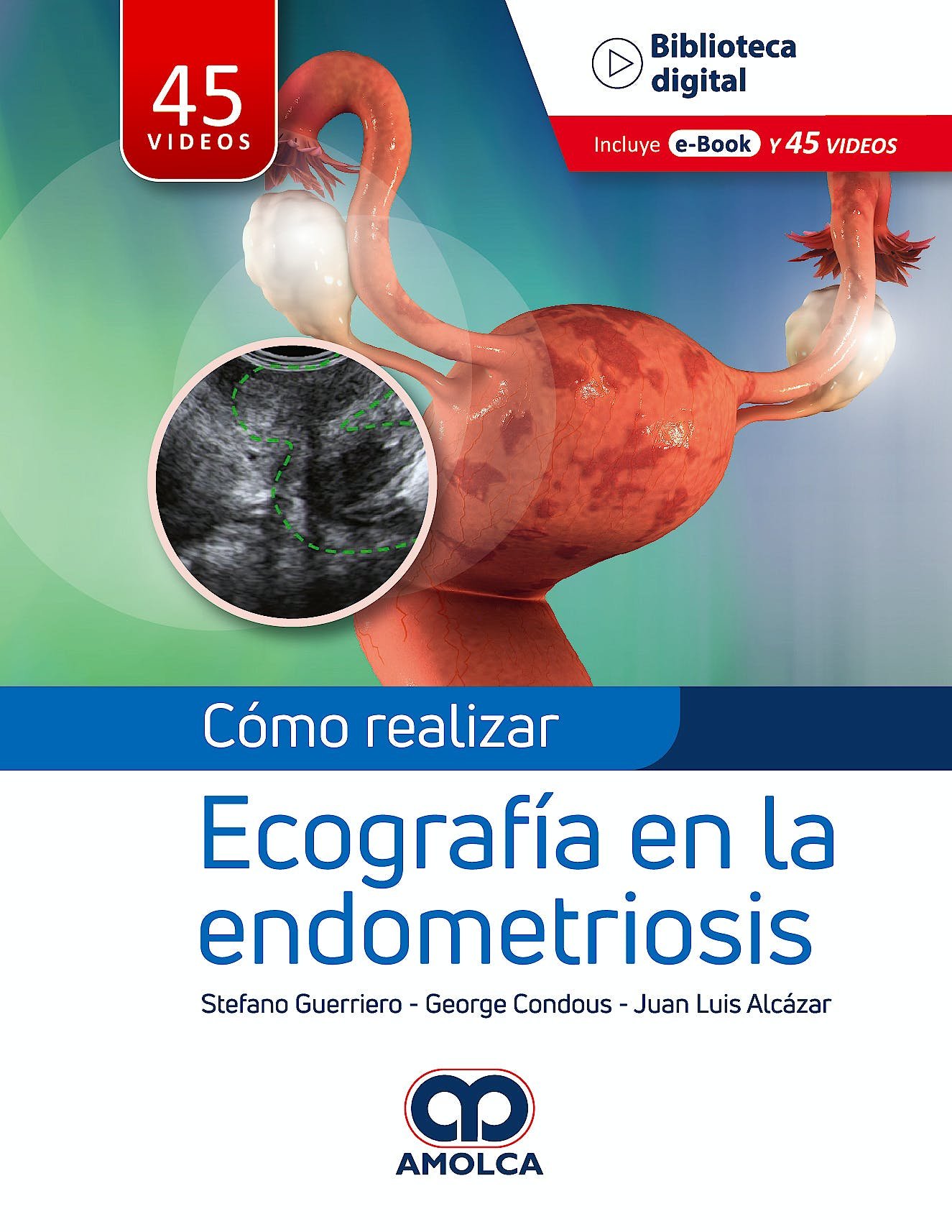 COMO REALIZAR ECOGRAFIA EN LA ENDOMETRIOSIS - Imagen 2