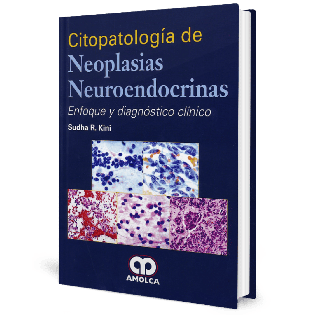 Citopatologia de Neoplasias Neuroendocrinas Kini