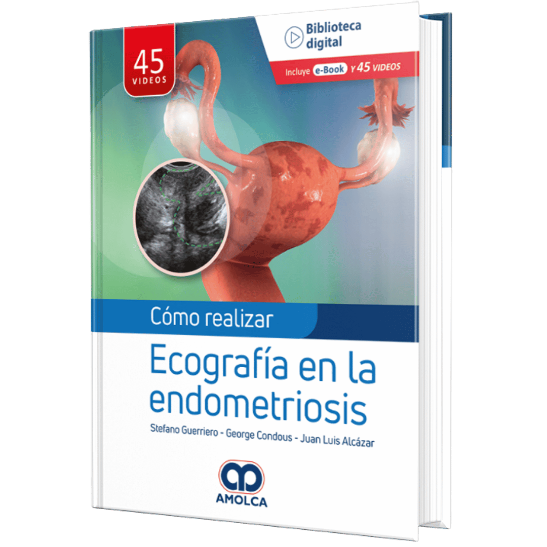 COMO REALIZAR ECOGRAFIA EN LA ENDOMETRIOSIS - Imagen 1