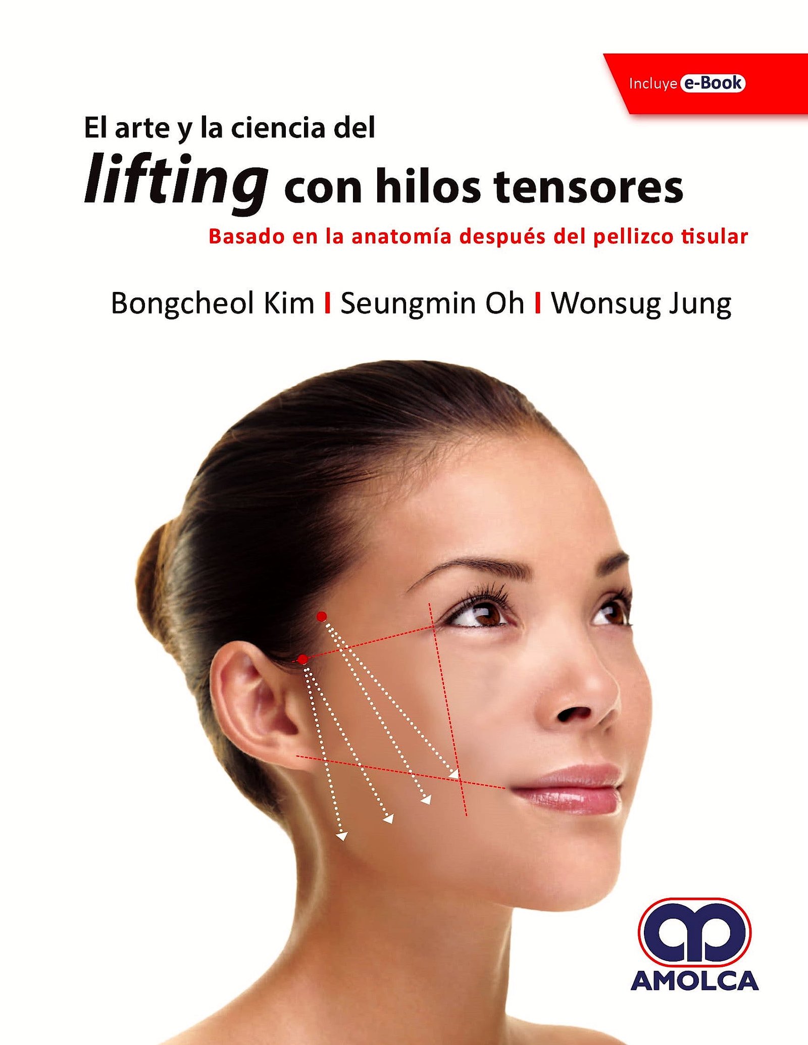 EL ARTE Y LA CIENCIA DEL LIFTING CON HILOS TENSORES BASADO EN LA ANATOMIA DESPUES DEL PELLIZCO TISULAR - KIM
