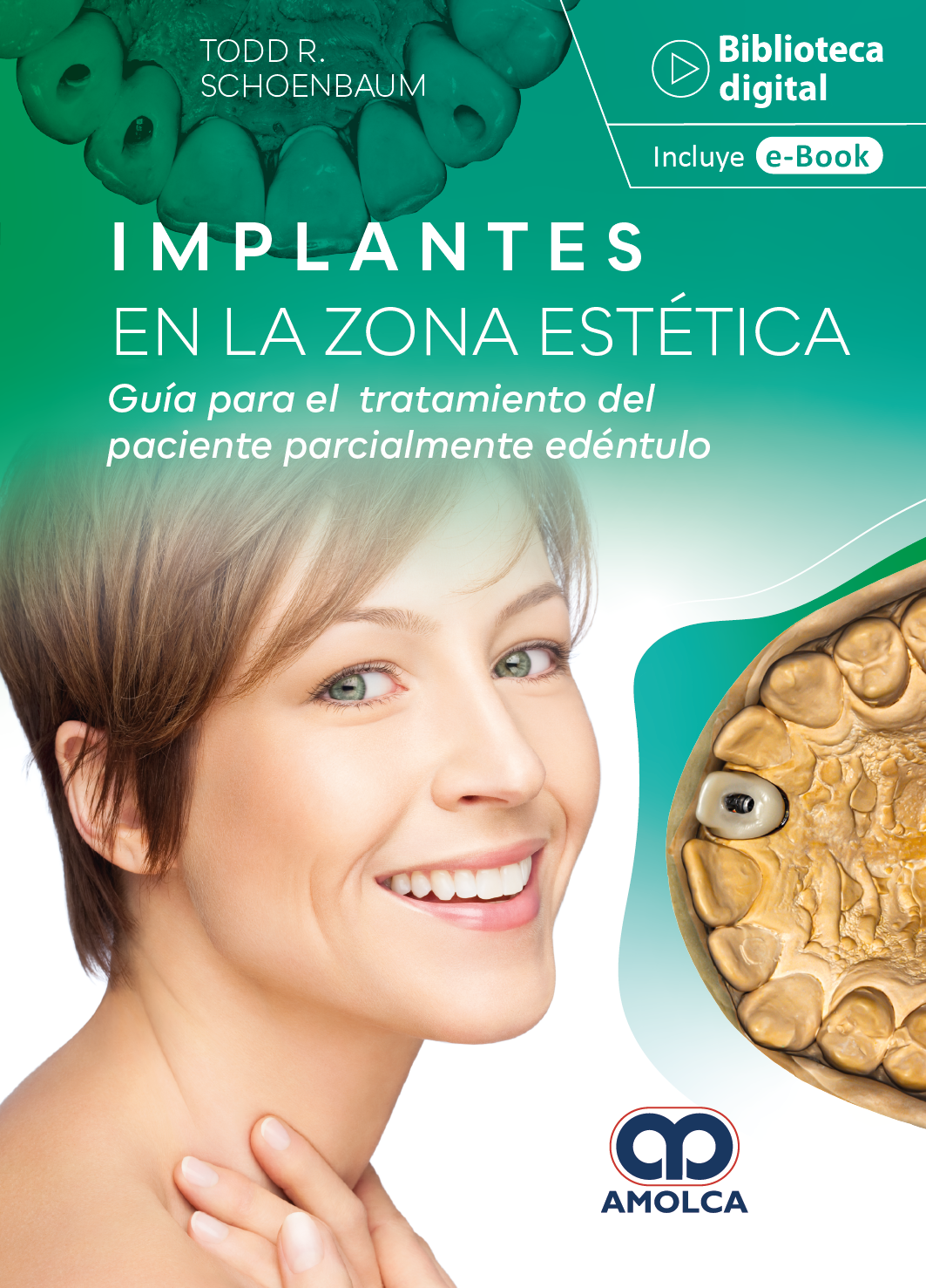 IMPLANTES EN LA ZONA ESTETICA GUIA PARA EL TRATAMIENTO DEL PACIENTE PARCIALMENTEEDENTULO - SCHOENBAUM