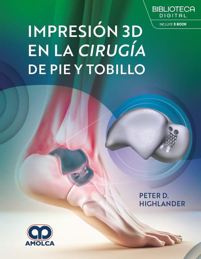 IMPRESION 3D EN LA CIRUGIA DE PIE Y TOBILLO - HIGHLANDER