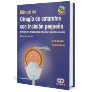 MANUAL DE CIRUGIA DE CATARATAS CON INCISION PEQUEÑA