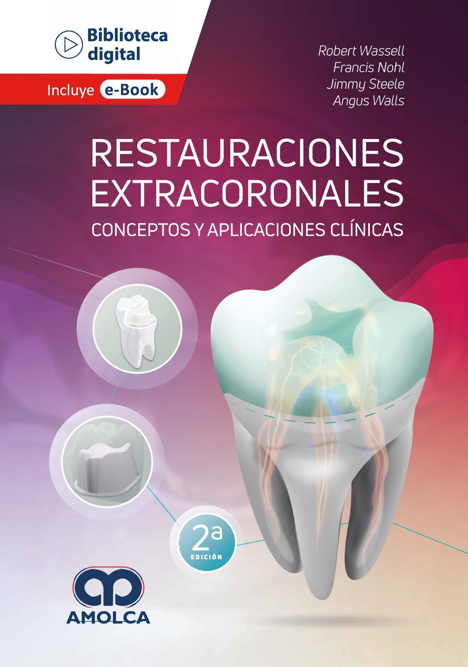 RESTAURACIONES EXTRACORONALES CONCEPTOS Y APLICACIONES CLINICAS - WASSELL