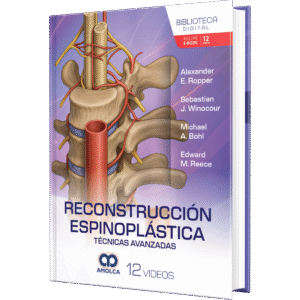 RECONSTRUCCION ESPINOPLASTICA TECNICAS AVANZADAS