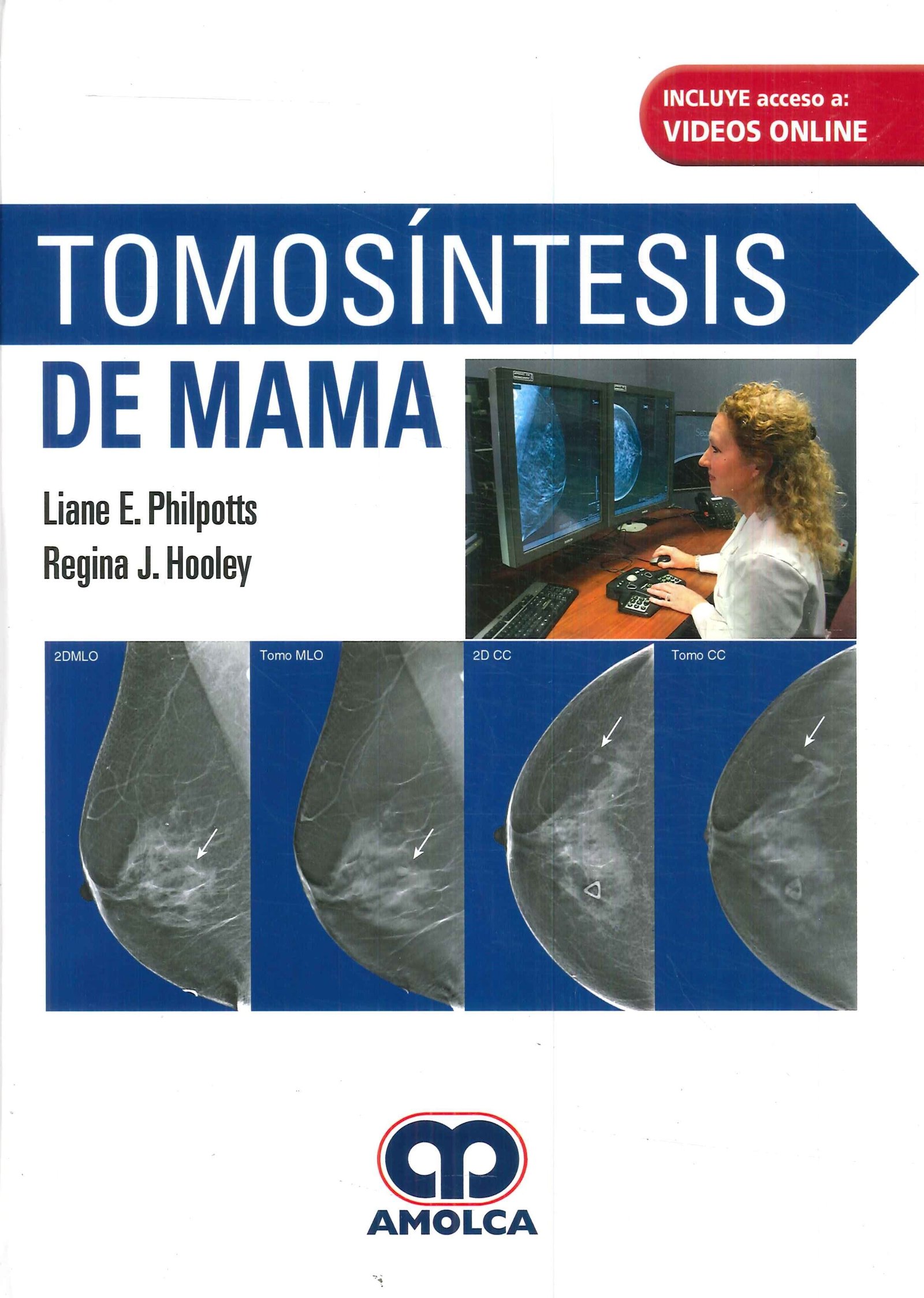 TOMOSINTESIS DE MAMA - PHILPOTTS