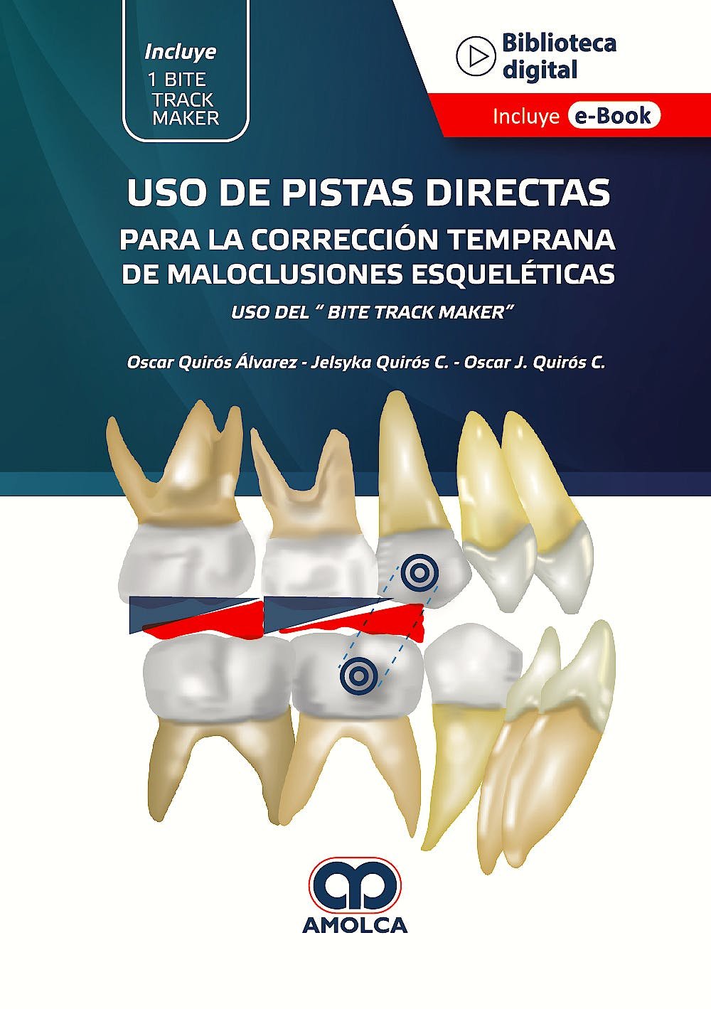 USO DE PISTAS DIRECTAS PARA LA CORRECCION TEMPRANA DE MALOCLUSIONES ESQUELETICAS - QUIROS